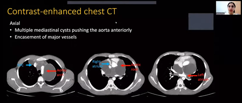  Mediastinal hydatid disease: a case report Neda Khalili Iran